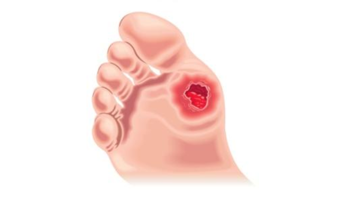 A Guide to Diabetic Foot Amputation and Recovery - Thomas Podiatry &  Associates
