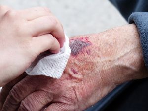 5 Reasons Why Wounds Won't Heal 