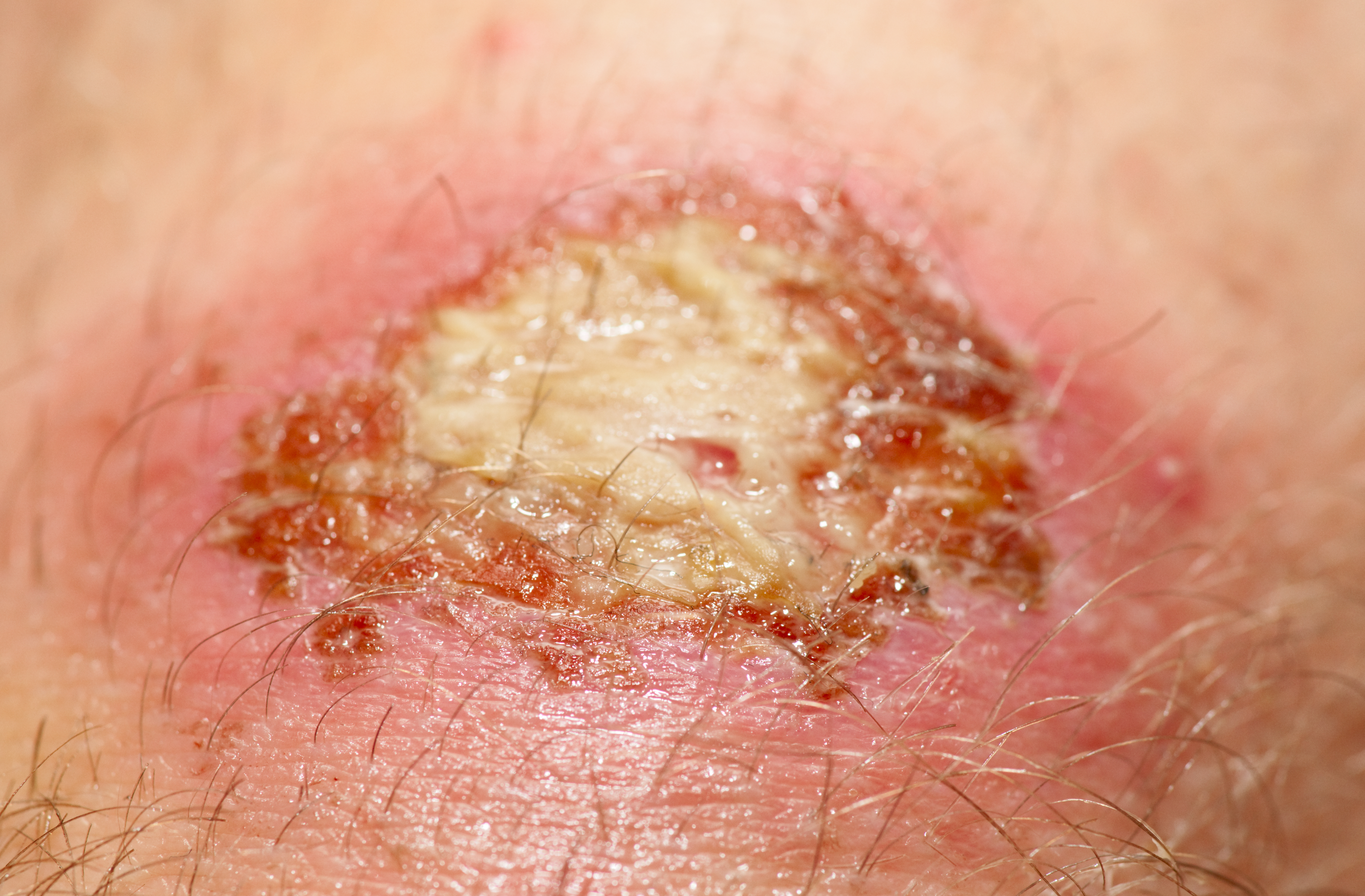 Wound with red edges and yellow slough