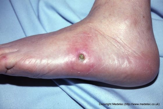Diabetic Foot Ulcers Tribunsantri Com