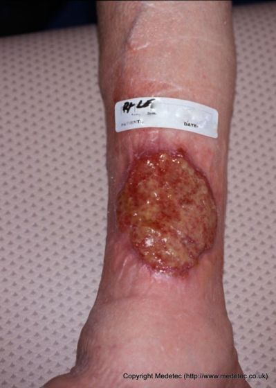 Venous Insufficiency Ulcers Symptoms And Treatment - 