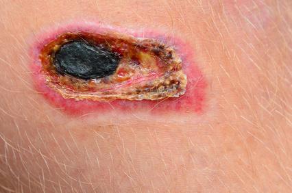 Biofilm And Delayed Or Impaired Wound Healing Woundsource